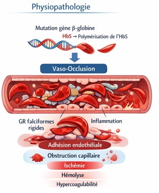 Drépanocytose physiopathologie crise aigue