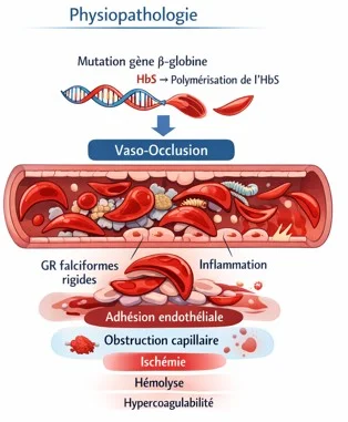 Physiopathologie Drépanocytose physiopathologie crise aigue
