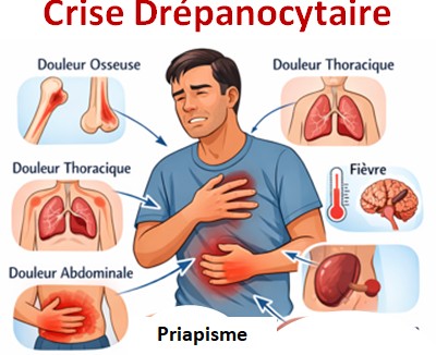 Drépanocyte signes cliniques