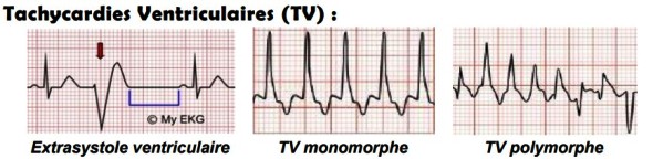 Tachycardie ventriculaire monomorphe et polymorphe