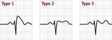 Syndrome de Brugada, signes ECG