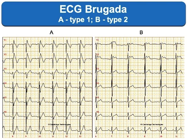 ECG Brugada, signes électrocardiogramme type 1 et type 2 ECG Brugada, signes électrocardiogramme type 1 et type 2