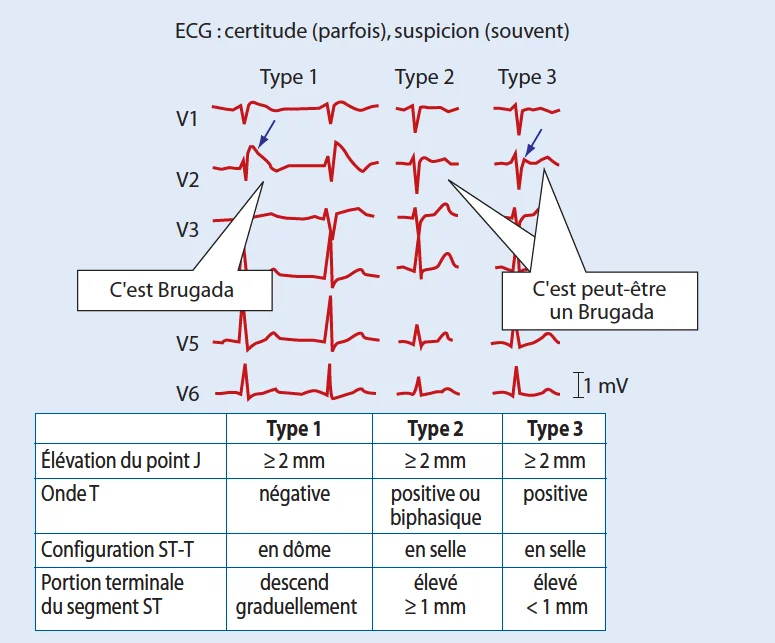 Brugada syndrome, diagnostic ECG, signes de certitude Brugada syndrome, diagnostic ECG, signes de certitude
