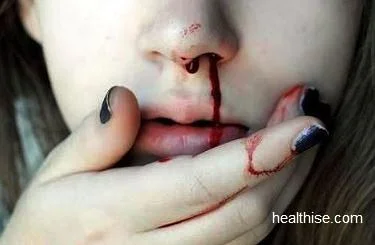 épistaxis, conduite à tenir