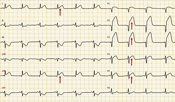 ECG infarctus STMI