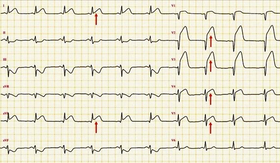 ECG infarctus STMI