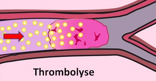 Thrombolyse, fibrinolytiques