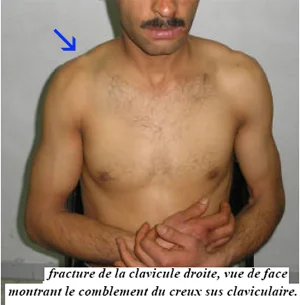 Fracture clavicule Facture de la clavicule, attitude vicieuse et déformation visible