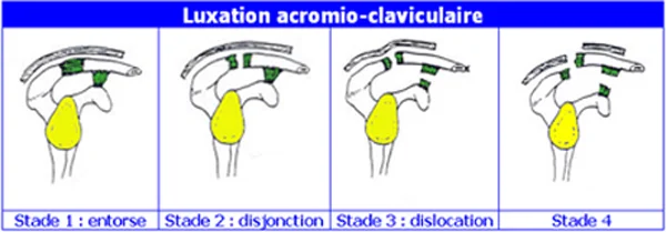 luxation acromio-claviculaire, classification