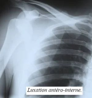 Radiologie, luxation de l'épaule