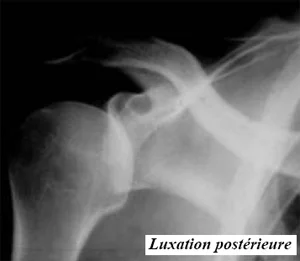 Radiographie, luxation postérieure de l'épaule