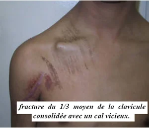 fracture de la clavicule avec cal vicieux