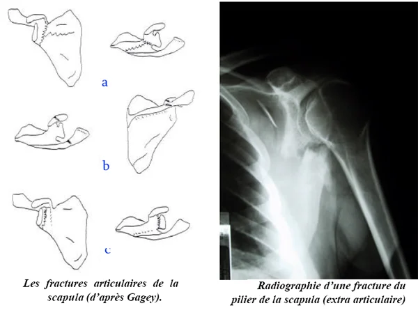 Fracture de la scapula, classification, radiographie