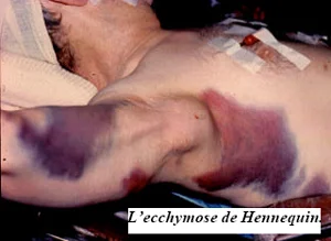 Fracture de l'humérus, ecchymose, signes cutanés