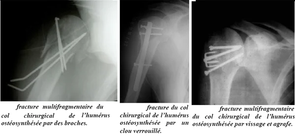Radiographie de l'épaule, enclouage fracture de l'humérus
