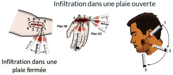 rage serothérapie