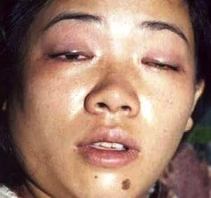 Ptose et grimace Signes neurologiques d'intoxication ophidienne
