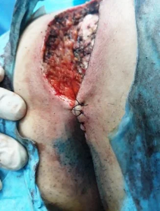 Résection chirurgicale kyste pilonidal Résection chirurgicale kyste pilonidal