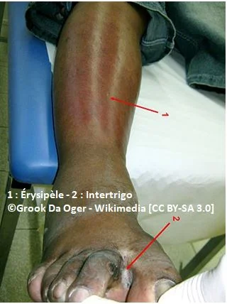 érysipèle, infection cutanée