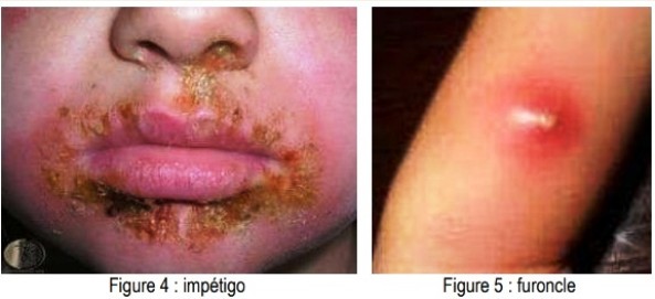 Infections cutanées à staphylocoque, impétigo et furoncle