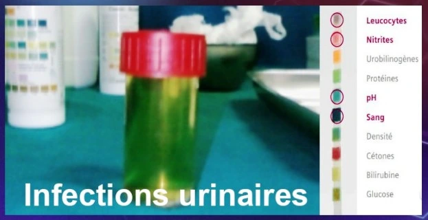 Infections urinaires, cystites et pyélonéphrites, traitement antibiotiques Infections urinaires, cystites et pyélonéphrites, traitement antibiotiques