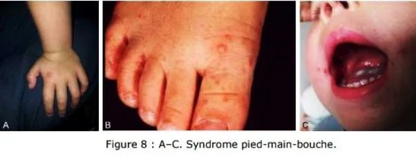 Syndrome main pied bouche Syndrome main pied bouche