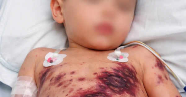 Méningite et purpura fulminans