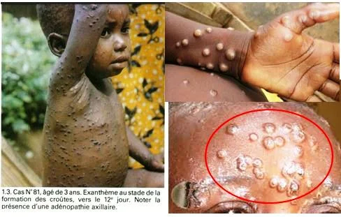 éruptions de variole de singe monkeypox ou variole de singe
