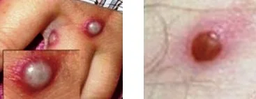 Virus Monkeypox signes cutanées