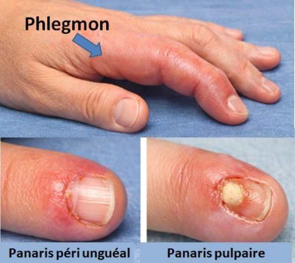 phlegmon, panaris, infections de la main