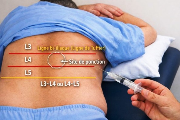 Position de ponction lombaire