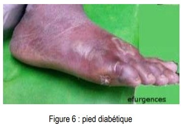 Infections cutanées, pied de diabétique