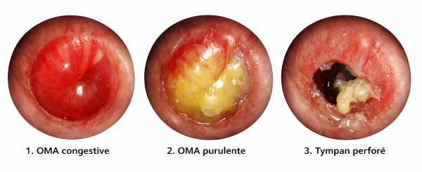 Aspect du tympan dans les otites
