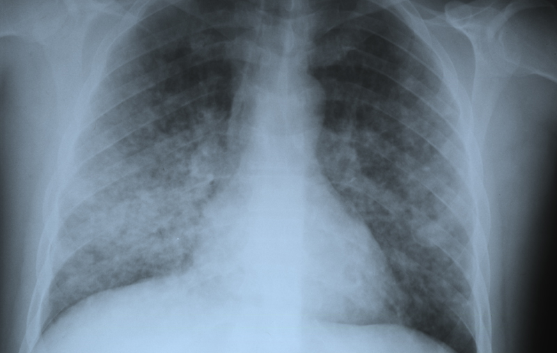 Radiographie pneumonie à varicelle