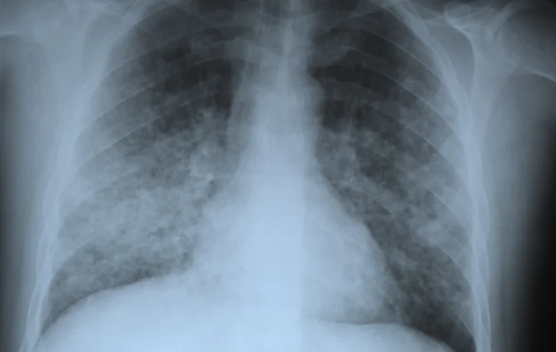 Radiographie pneumonie varicelleuse