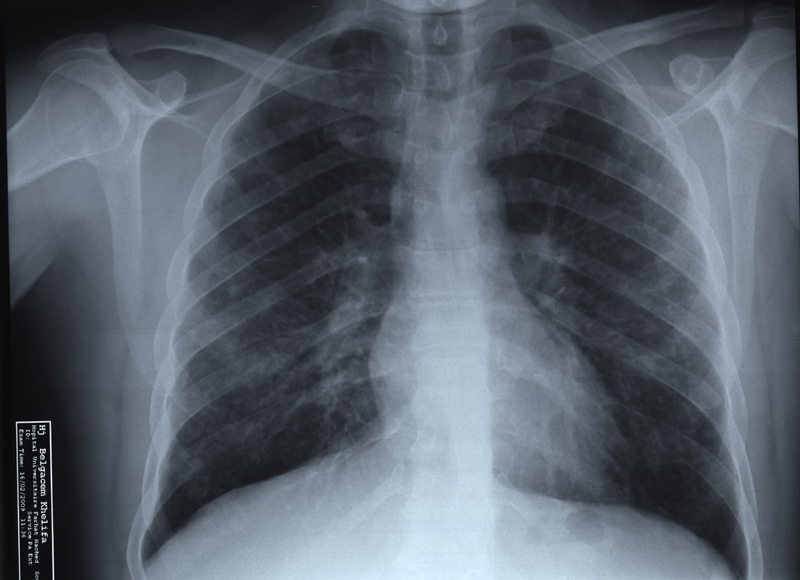 Radiographie Thorax après guerison Radiographie des poumons