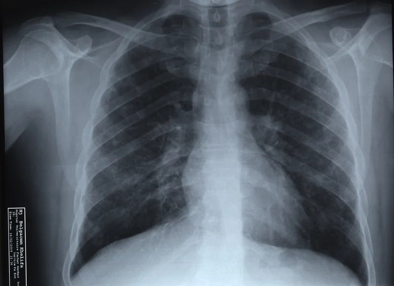 Radiographie des poumons