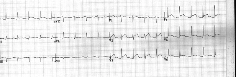 ECG