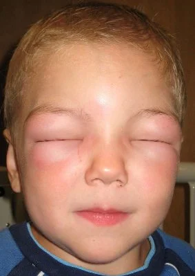 Signes d'allergie et traitement, œdème de Quincke Signes d'allergie et traitement, œdème de Quincke