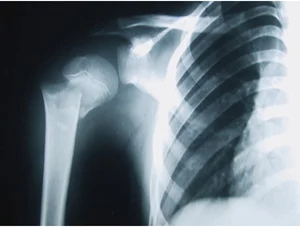 Radiographie de l'épaule