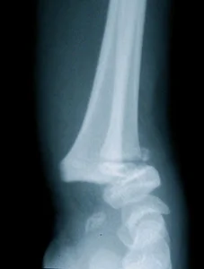Radiographie poignet fracture avec décollement