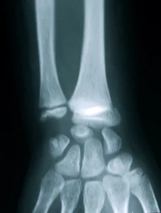 Radiographie poignet décollement épiphysaire