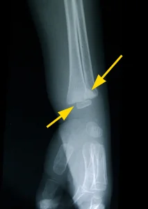 Radiographie poignet décollement épiphysaire