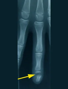 Radiographie fracture du doigt