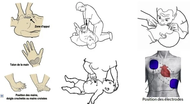Réanimation de l'arrêt cardiopulmonaire secourisme, position des mains Réanimation de l'arrêt cardiopulmonaire secourisme, position des mains