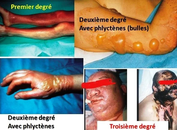 Cmassification Brulure cutanée classification surface et profondeur