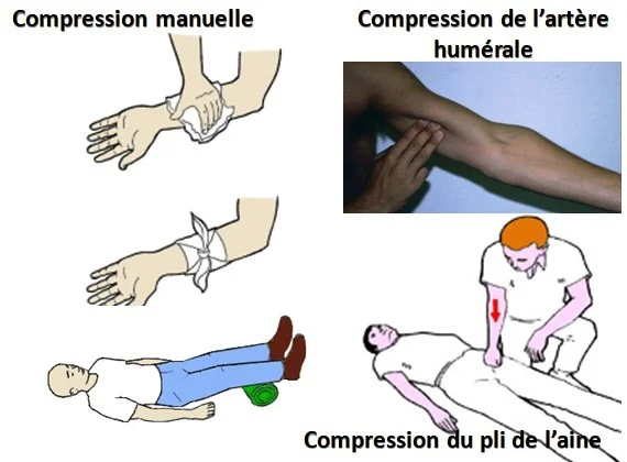 compression manuelle des plaies, formation secourisme