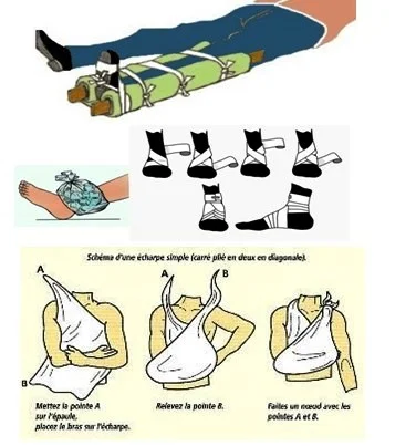 immobilisation des fractures par les secouristes