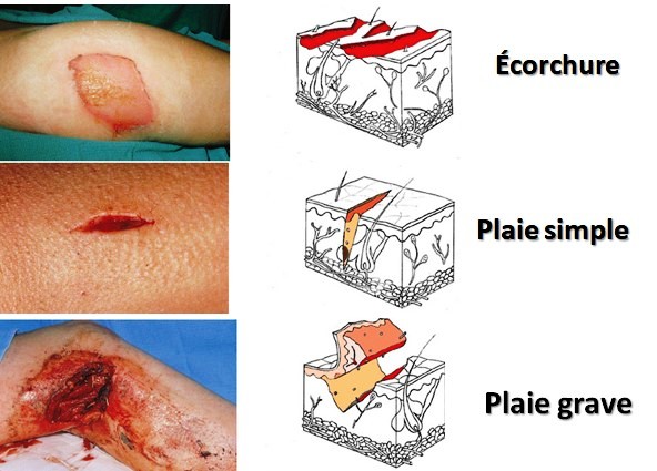 Secourisme : accidents et traumatismes