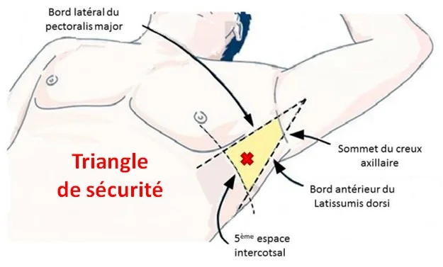 Triangle de securité Pleurésie, technique et lieu de ponction pleurale